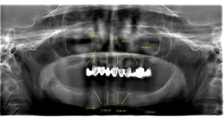 Panoramic X-ray before all-on-4
